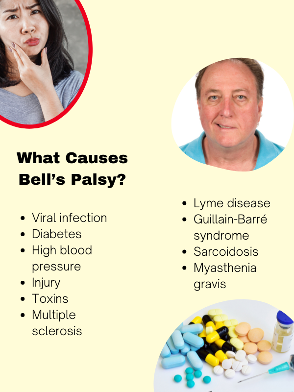 Bell's Palsy: What It Is, Causes, Symptoms & Treatment