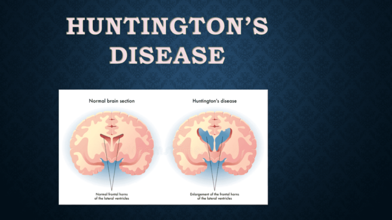 Huntingtons Disease Pictorial Presentation Neurohealth 5056