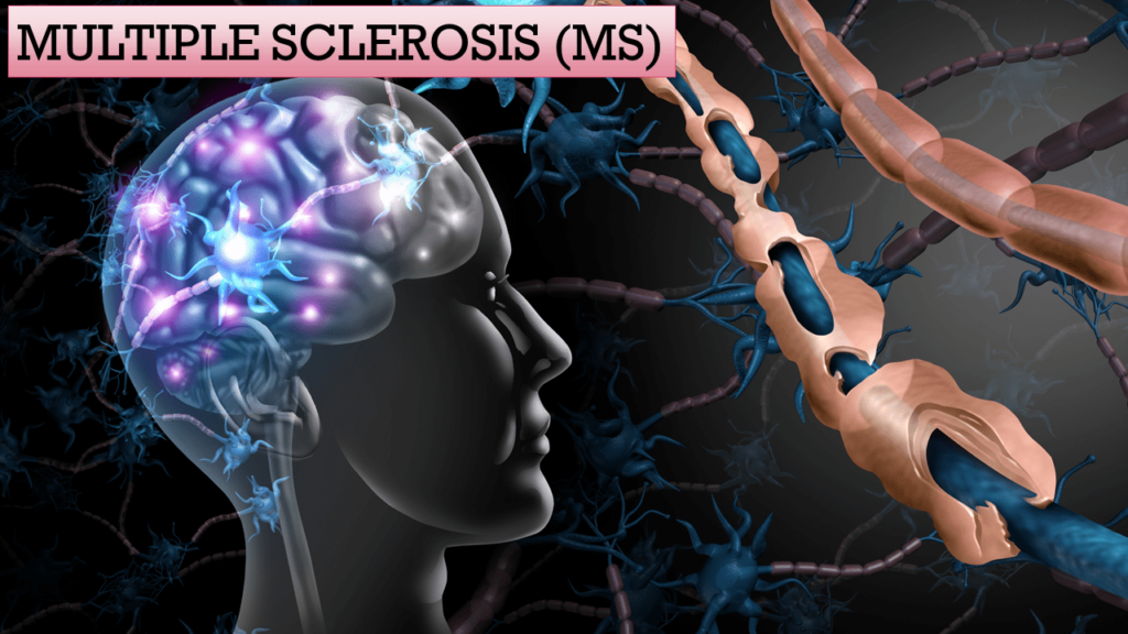 Multiple sclerosis Pictorial Presentation