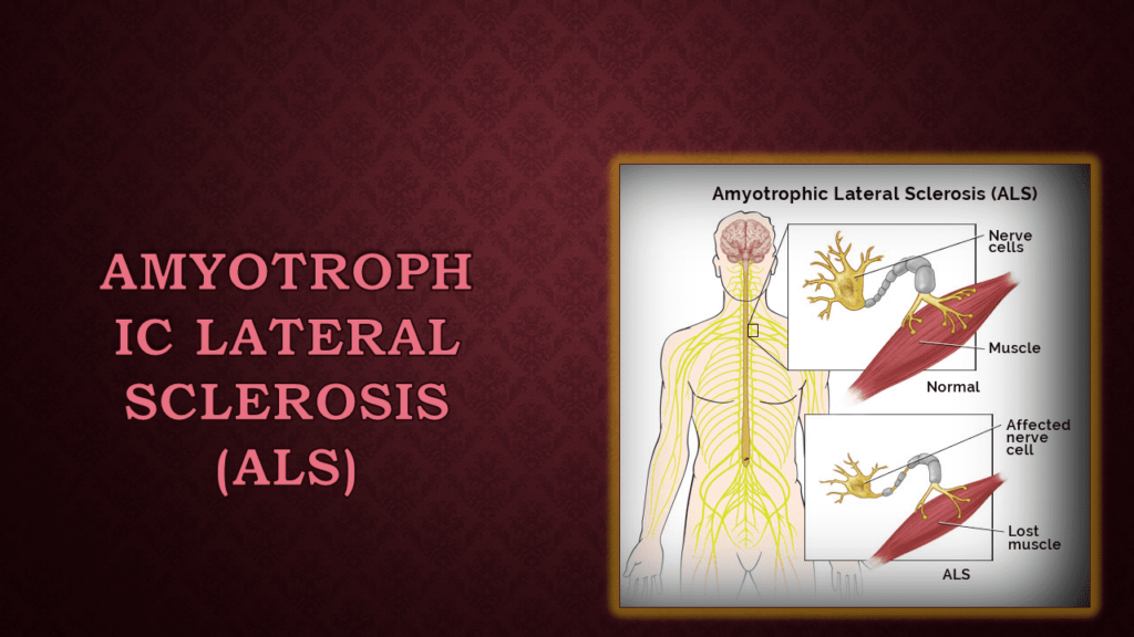 Amyotrophic lateral sclerosis (ALS) 
