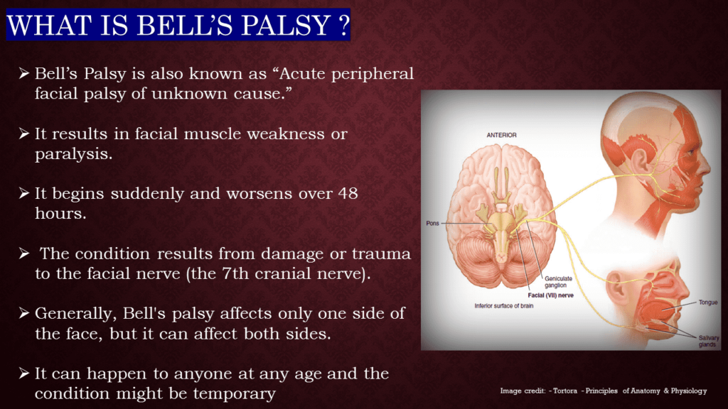 WHAT IS BELL’S PALSY ?

