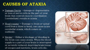 Ataxia: Lack of voluntary coordination of muscle movements - NeuroHealth