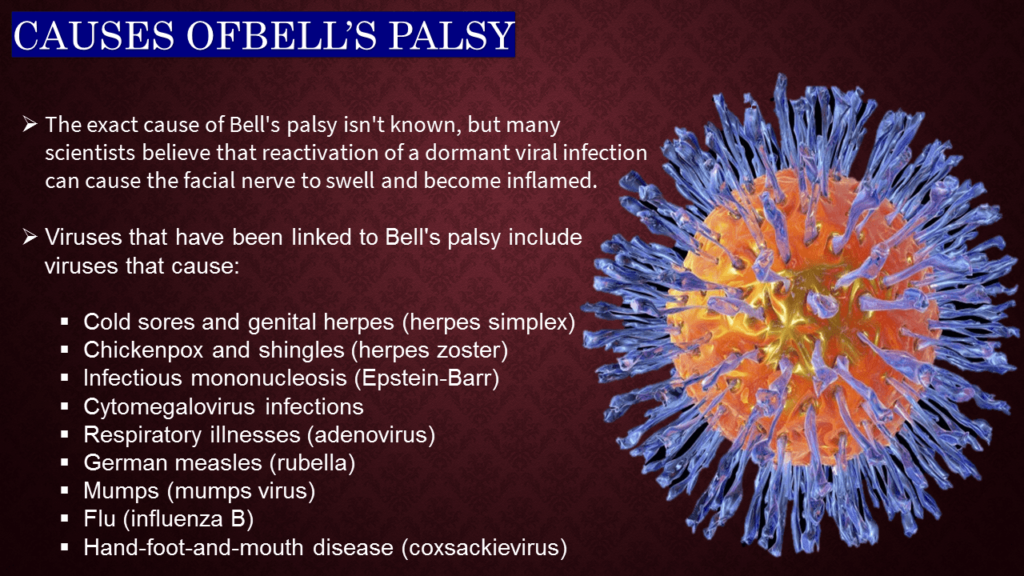 CAUSES OF BELL’S PALSY 
