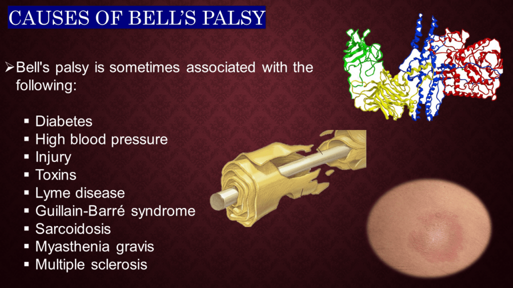 CAUSES OFBELL’S PALSY 

