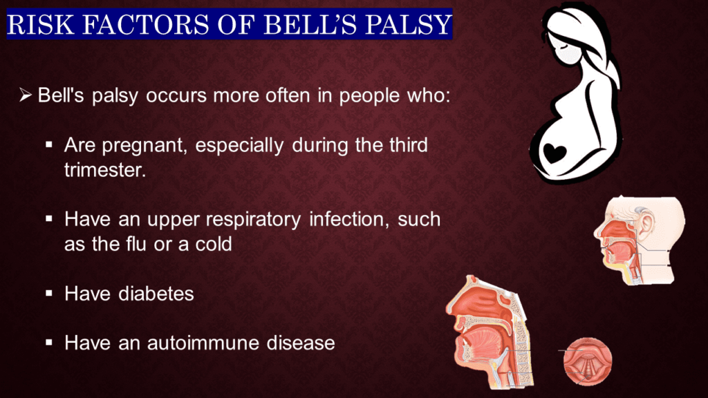 RISK FACTORS OF BELL’S PALSY 
