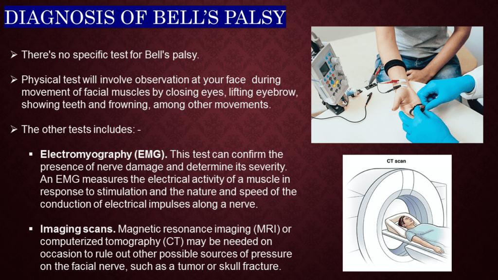 DIAGNOSIS OF BELL’S PALSY 
